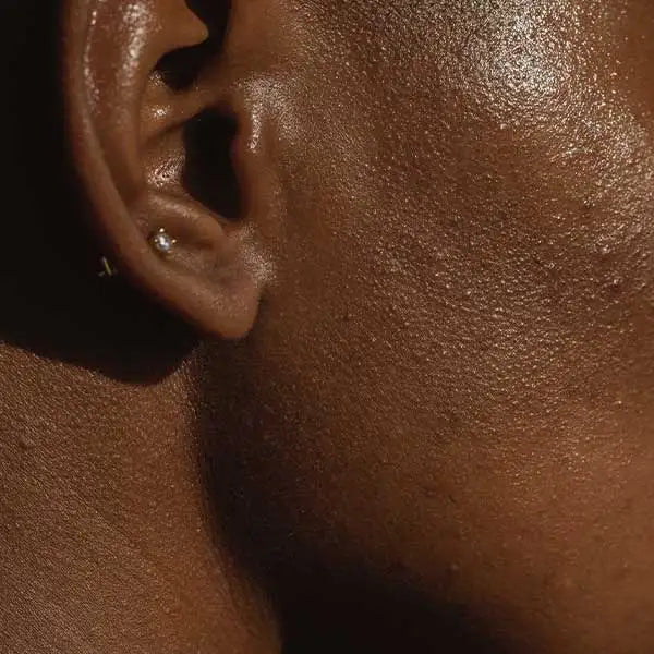 Different Types of Acne Scarring and How to Treat Acne Scarring