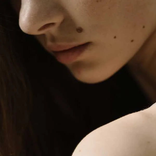 How to Treat Rosacea and Skin Redness